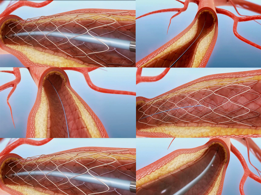 高清血管动脉扩张动画演示视频