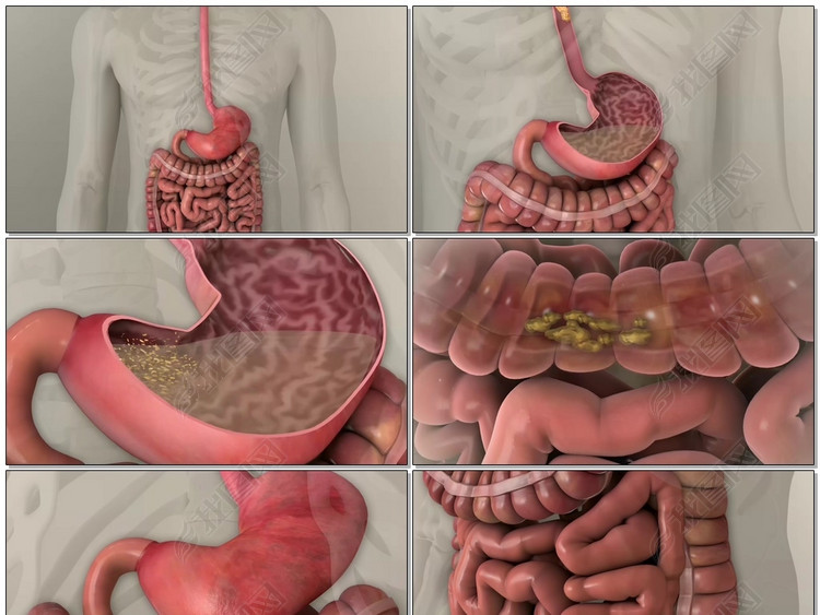 医学医疗肠胃肠易激综合症肠道胃病视频素材